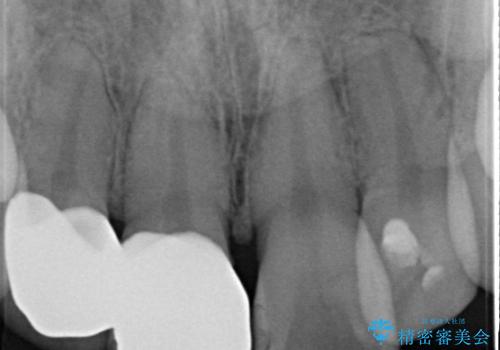 前歯2本の着色が気になる、、、セラミック治療の治療後