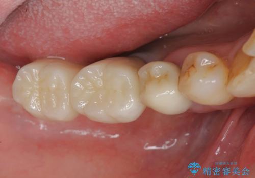 骨の造成を同時に行うインプラント治療の治療後