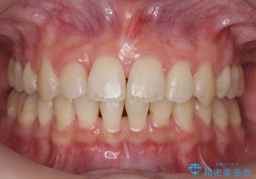 【難症例】歯並びが悪く、虫歯の治療ができない 矯正治療からスタートの治療後