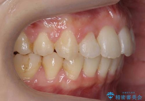 【難症例】歯並びが悪く、虫歯の治療ができない　矯正治療からスタートの治療後