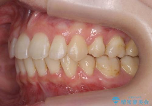 【難症例】歯並びが悪く、虫歯の治療ができない　矯正治療からスタートの症例 治療後