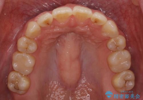 【難症例】歯並びが悪く、虫歯の治療ができない 矯正治療からスタートの治療後