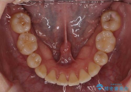 【難症例】歯並びが悪く、虫歯の治療ができない 矯正治療からスタートの治療後