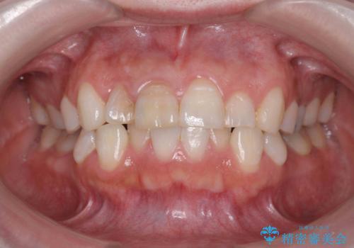 前歯の変色 セラミッククラウンによる審美性の回復の治療前