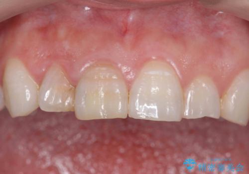 前歯の変色　セラミッククラウンによる審美性の回復の治療前