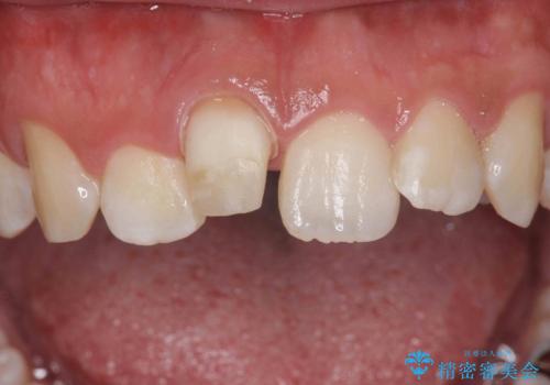 変色した前歯　根の治療とセラミックで白い歯にの治療中