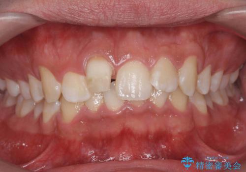 変色した前歯 根の治療とセラミックで白い歯にの治療中