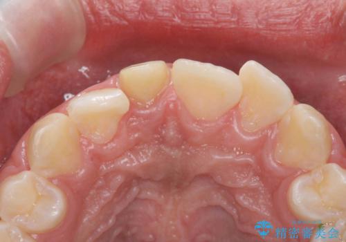 変色した前歯　根の治療とセラミックで白い歯にの治療中