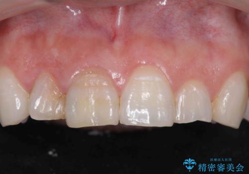 前歯の変色　セラミッククラウンによる審美性の回復の症例 治療前