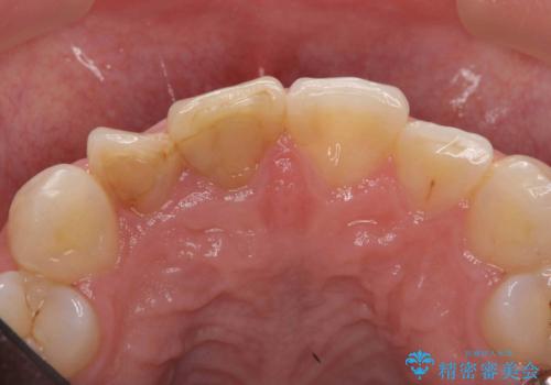 前歯の変色 セラミッククラウンによる審美性の回復の治療前