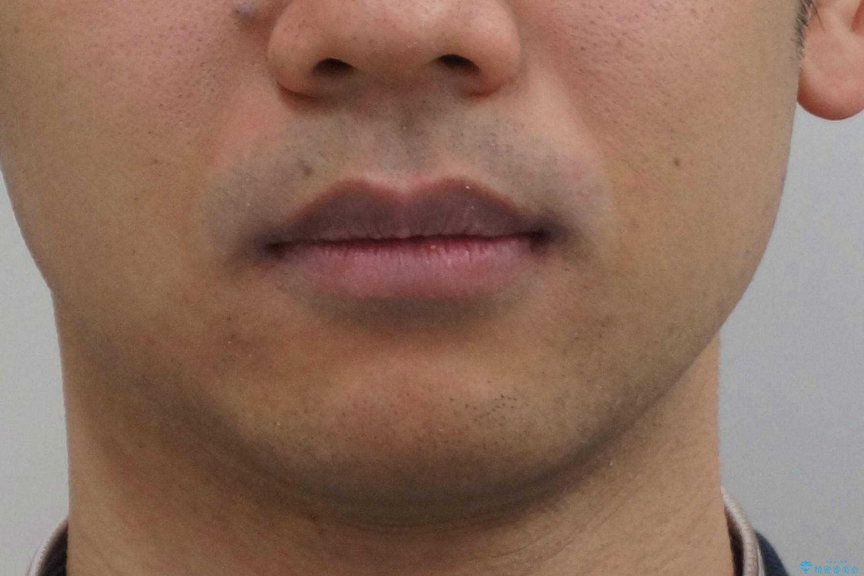 出っ歯を治したい 深いかみあわせ インビザラインで治療の治療後(顔貌)