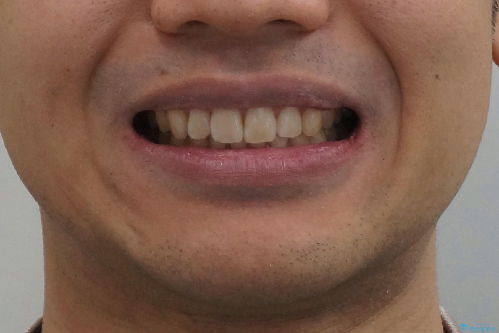 出っ歯を治したい 深いかみあわせ インビザラインで治療の治療後(顔貌)