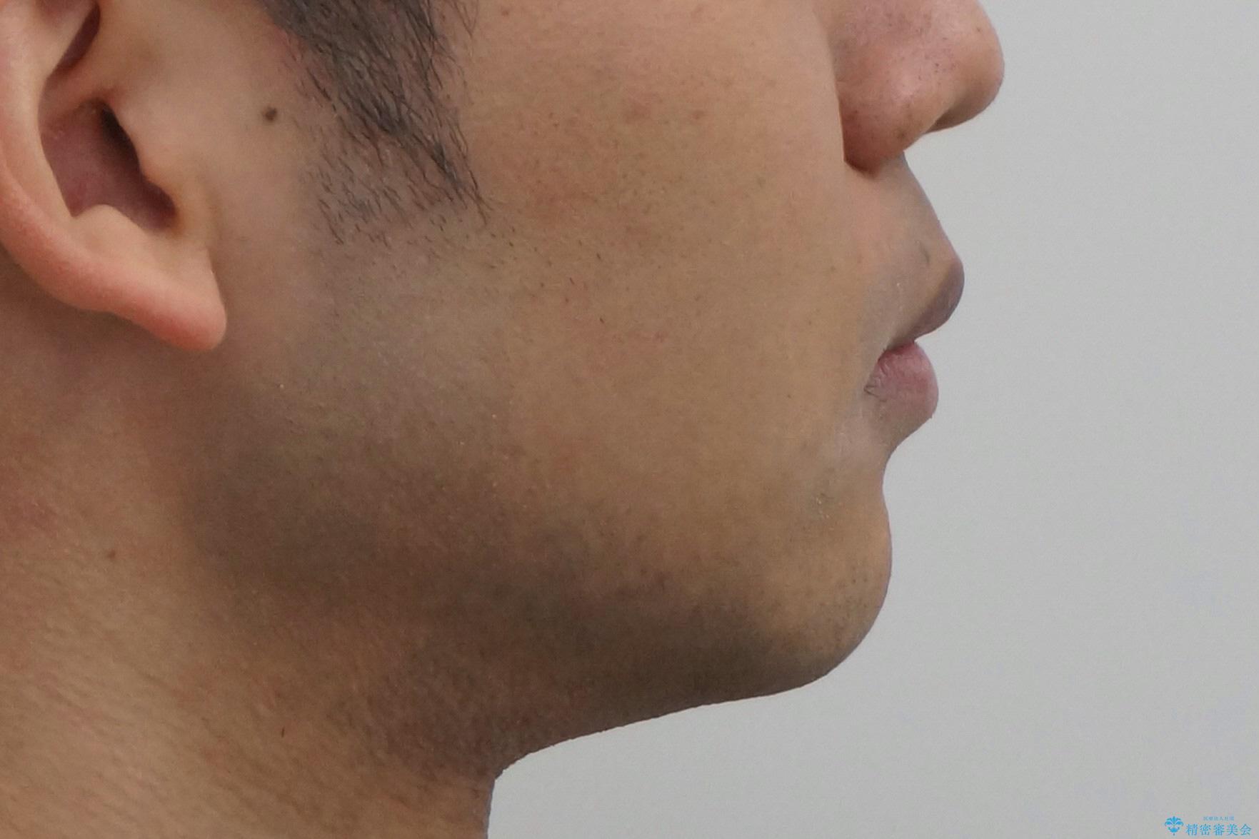 出っ歯を治したい 深いかみあわせ インビザラインで治療の治療後(顔貌)