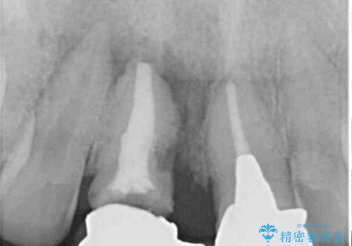 不自然な前歯 歯肉移植を用いた前歯のオールセラミックブリッジの治療前