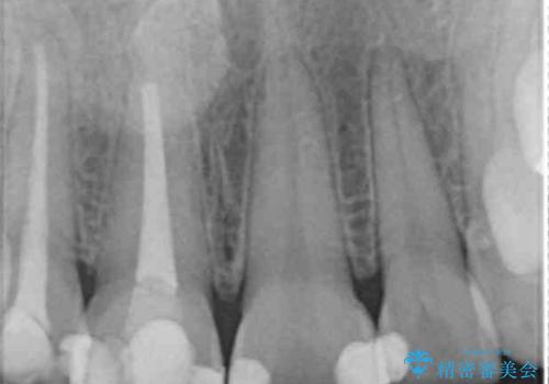 前歯の変色 セラミッククラウンによる審美性の回復の治療前