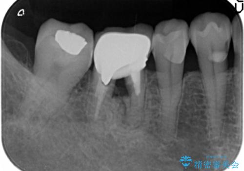 分岐部 Ⅲ 度病変による抜歯　小矯正後のブリッジ治療の治療前