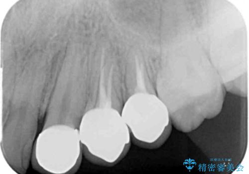 挺出小矯正を行った縁下カリエス治療の治療後