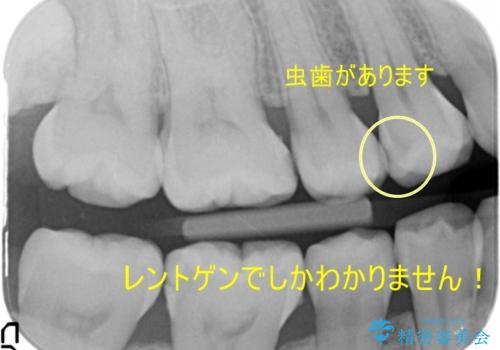 奥歯の虫歯 セラミックインレーで治療