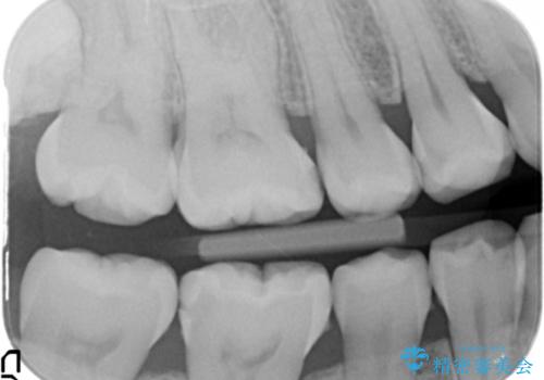 奥歯の虫歯 セラミックインレーで治療の治療前
