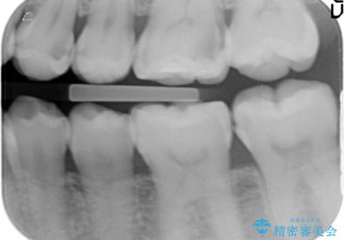 奥歯の虫歯 セラミックのつめものでやりかえの治療前