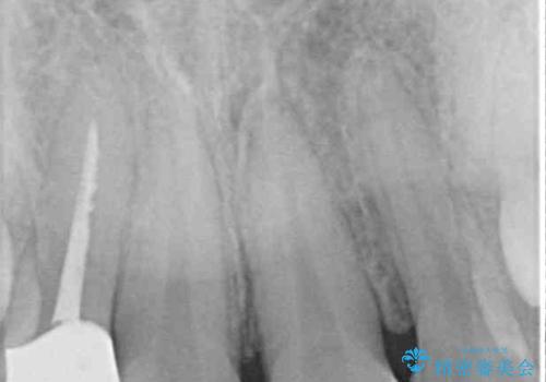 以前治療した前歯をきれいに治したい オールセラミッククラウンの治療後