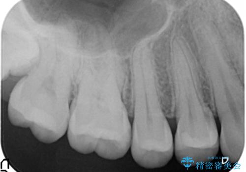 奥歯の虫歯　セラミックインレーで治療の治療後
