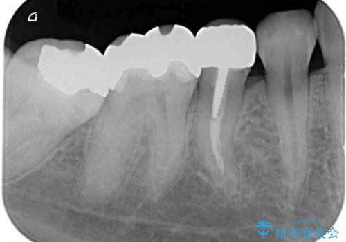 下の奥歯の虫歯をゴールドインレーで治療の治療後