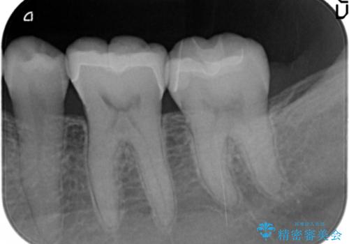 奥歯の虫歯　セラミックのつめものでやりかえの治療後