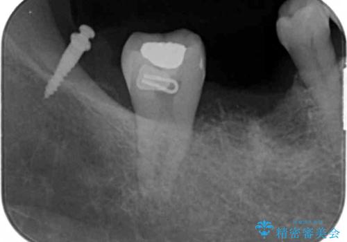 分岐部 Ⅲ 度病変による抜歯　小矯正後のブリッジ治療の治療中