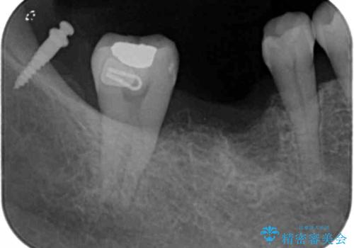 分岐部 Ⅲ 度病変による抜歯　小矯正後のブリッジ治療の治療中