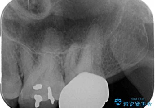ものが詰まるから、治療してほしい セラミック治療の治療後