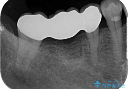 分岐部 Ⅲ 度病変による抜歯　小矯正後のブリッジ治療の治療後
