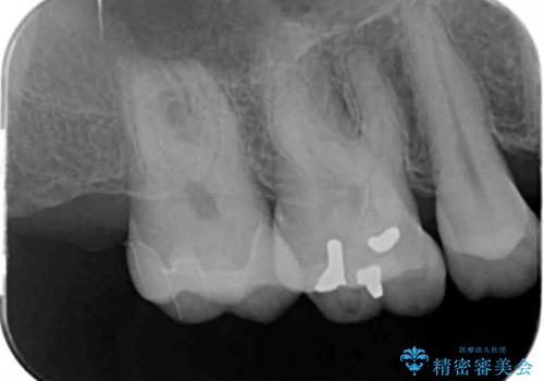 昔治療した銀歯を綺麗なセラミックに変えたい セラミックインレーの治療後