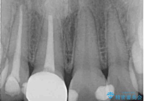 前歯の変色 セラミッククラウンによる審美性の回復の治療後