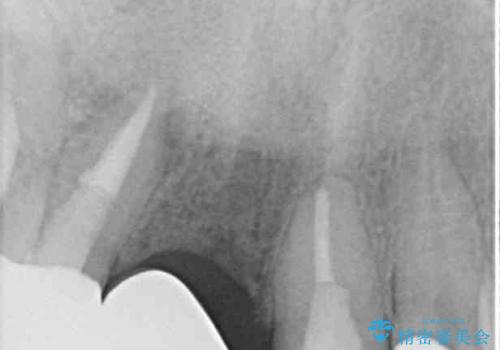不自然な前歯 歯肉移植を用いた前歯のオールセラミックブリッジの治療後