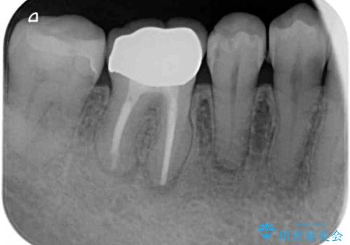奥歯に物が挟まる　セラミックインレーによる虫歯治療の治療後