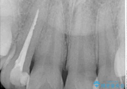 以前治療した前歯をきれいに治したい オールセラミッククラウンの治療前