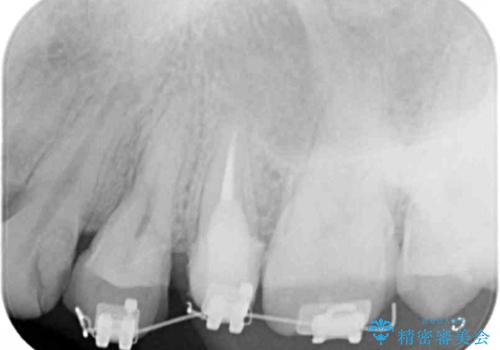 挺出小矯正を行った縁下カリエス治療の治療前