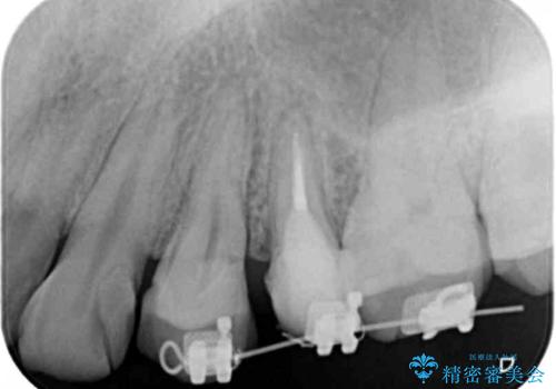 挺出小矯正を行った縁下カリエス治療の治療前