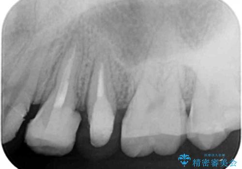 挺出小矯正を行った縁下カリエス治療の治療中