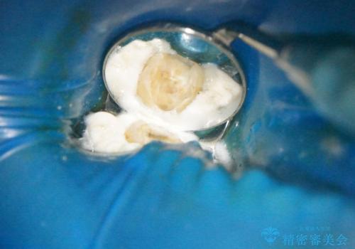 【フルジルコニアクラウン】他院で治療したクラウンが外れたの治療中