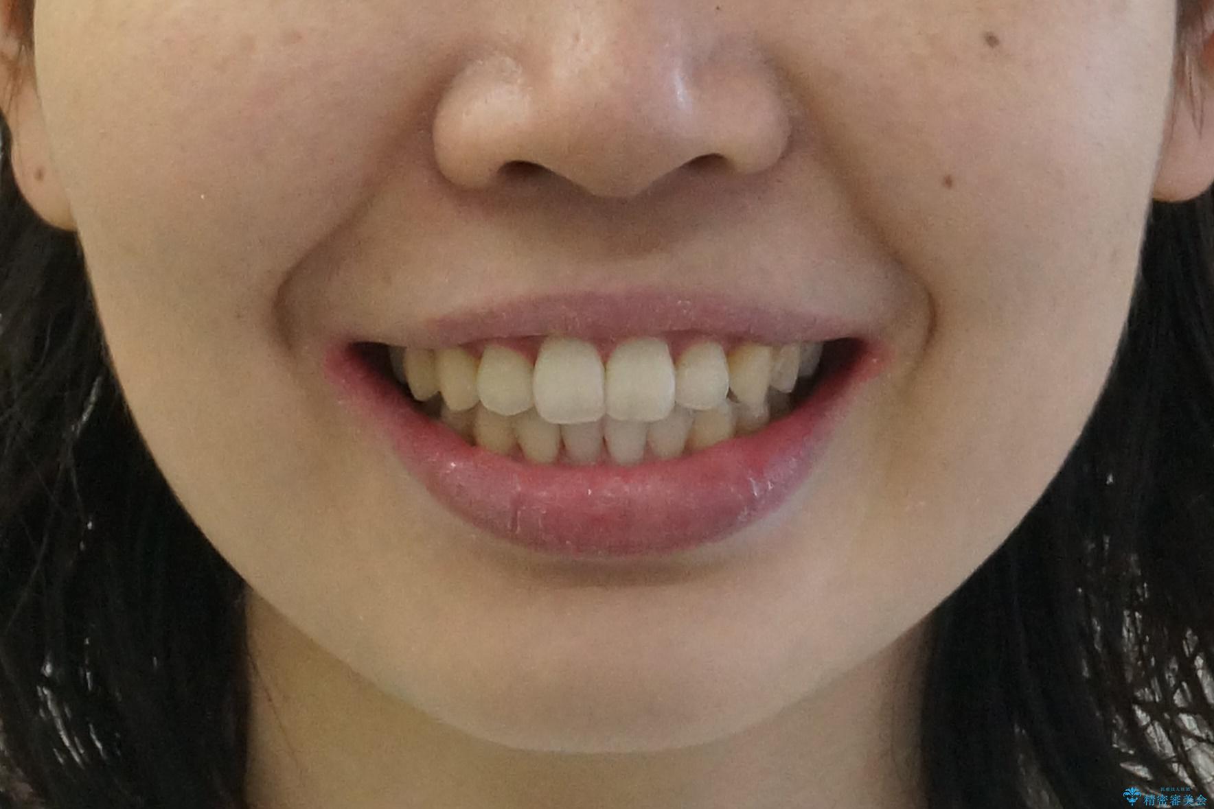 インビザライン モニターで前歯をきれいにの治療後(顔貌)