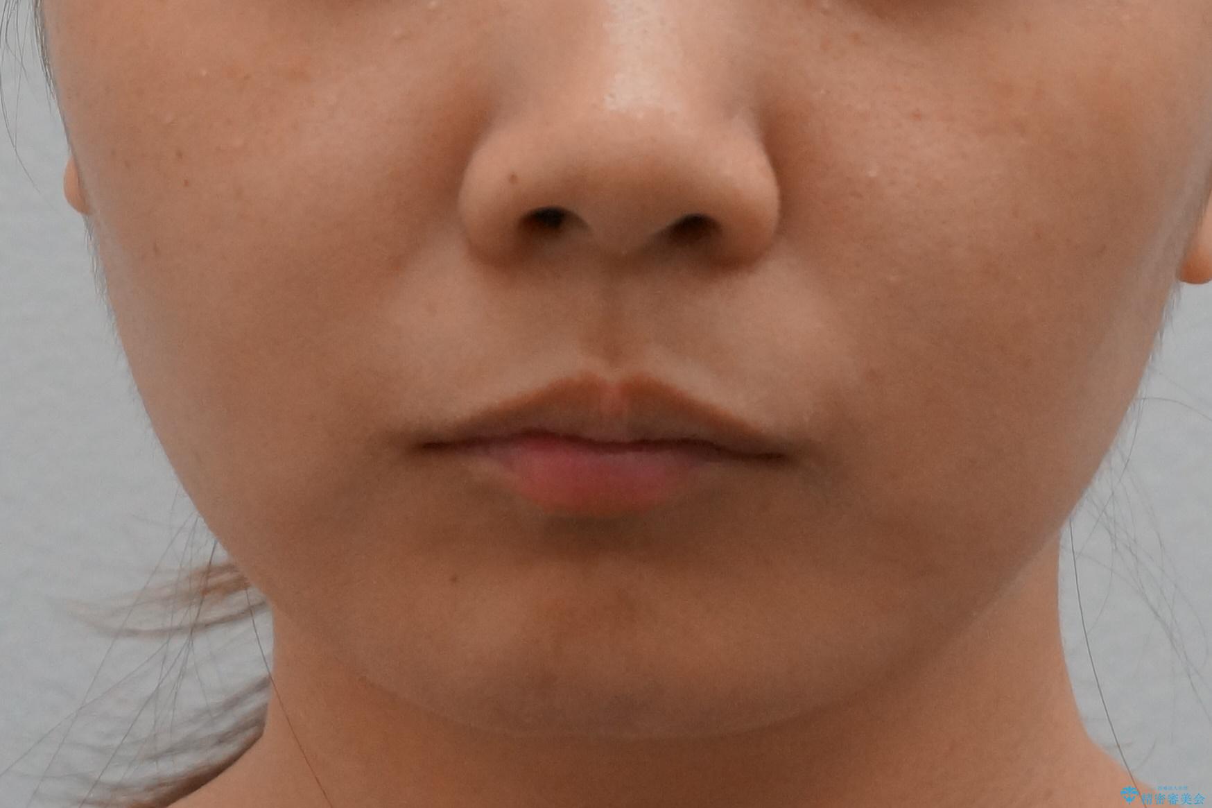 【難症例】歯並びが悪く、虫歯の治療ができない 矯正治療からスタートの治療前(顔貌)