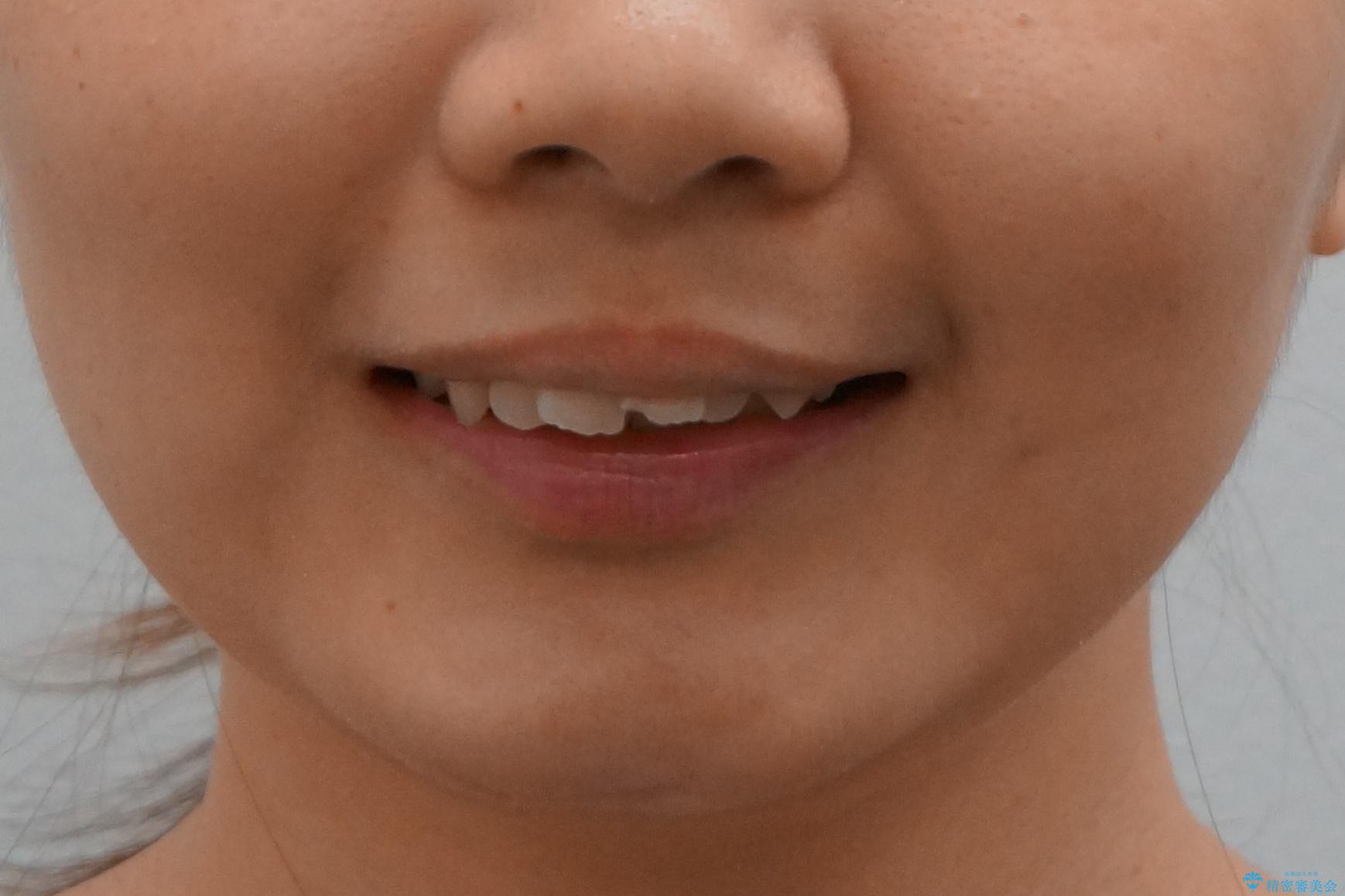 【難症例】歯並びが悪く、虫歯の治療ができない 矯正治療からスタートの治療前(顔貌)