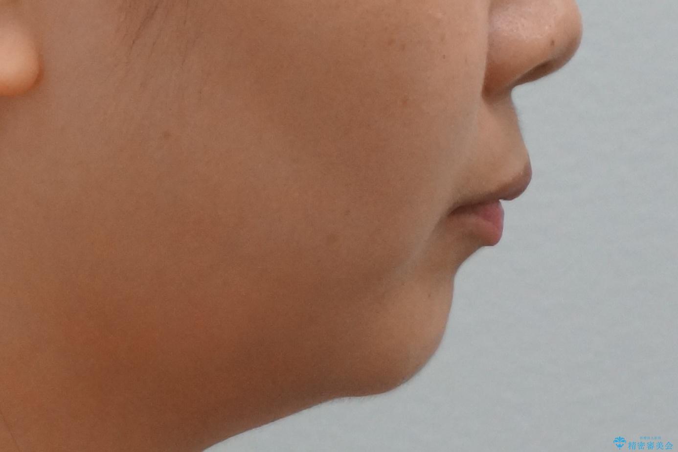 【難症例】歯並びが悪く、虫歯の治療ができない 矯正治療からスタートの治療前(顔貌)