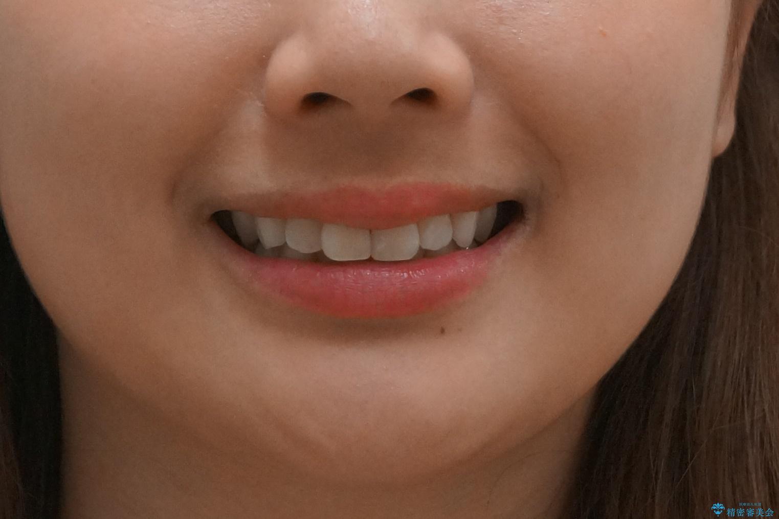 昔ワイヤー矯正をして後戻りした 軽度のがたつき モニター矯正の治療前(顔貌)