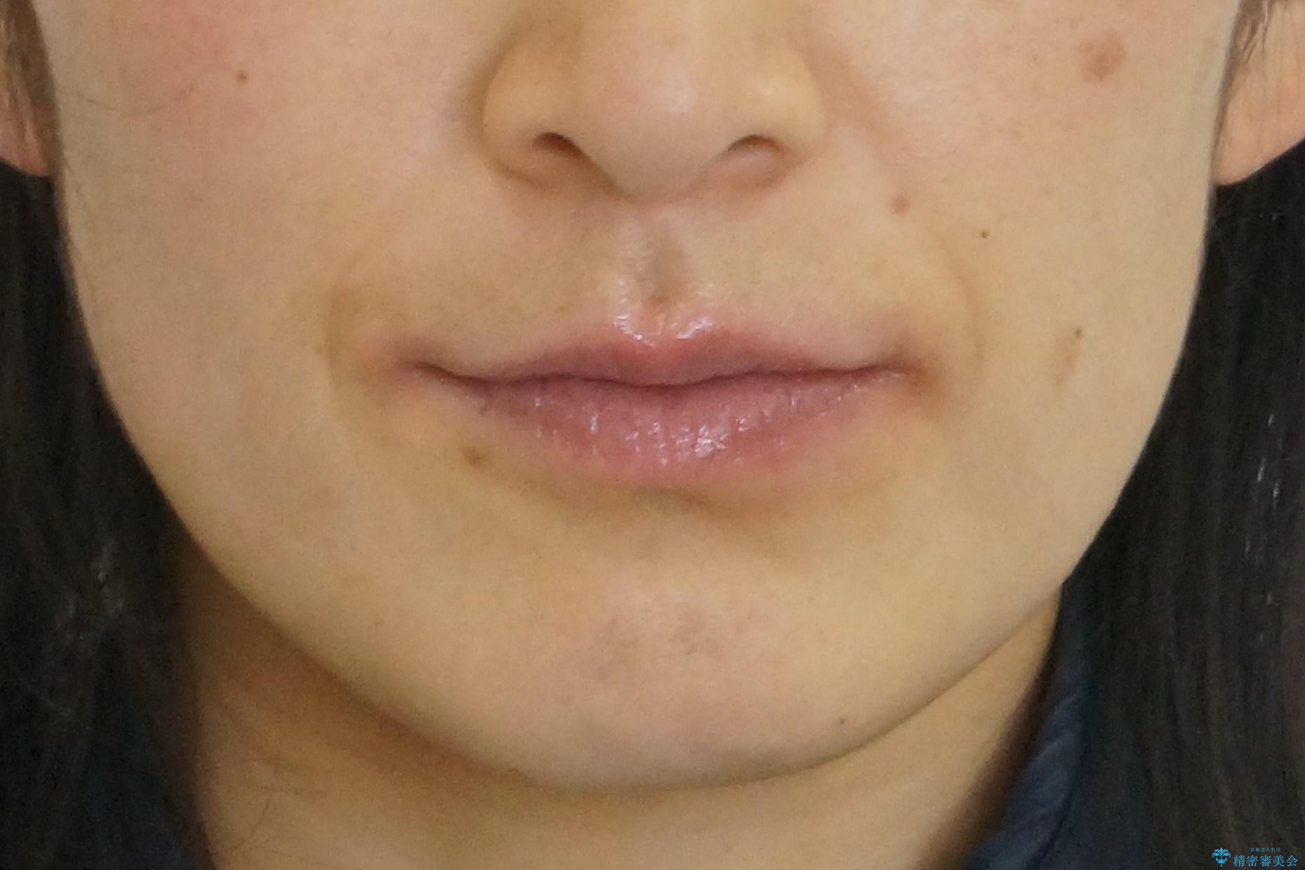 八重歯 上下の正中のずれ 40代で抜歯矯正の治療後(顔貌)