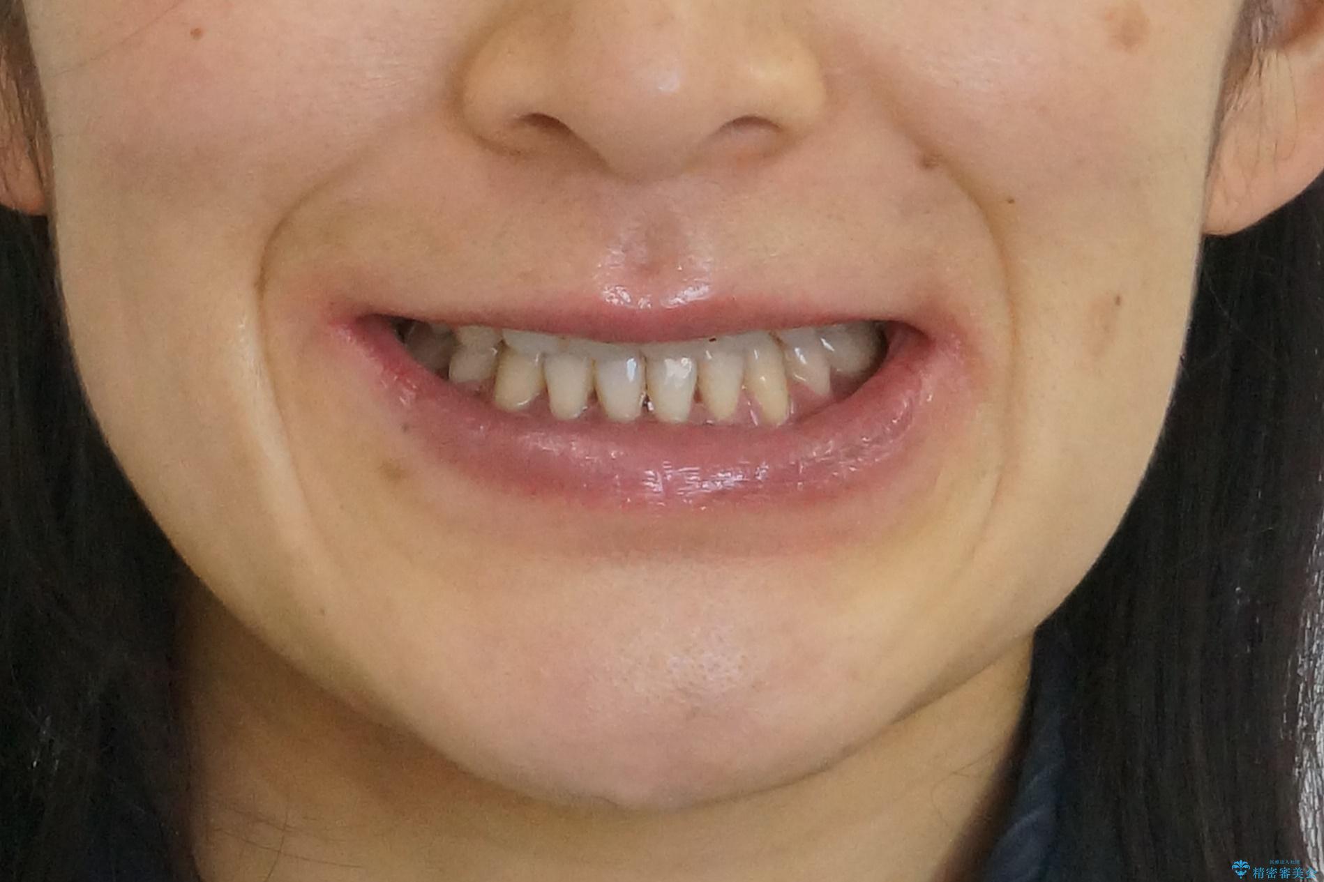 八重歯　上下の正中のずれ　40代で抜歯矯正の治療後（顔貌）