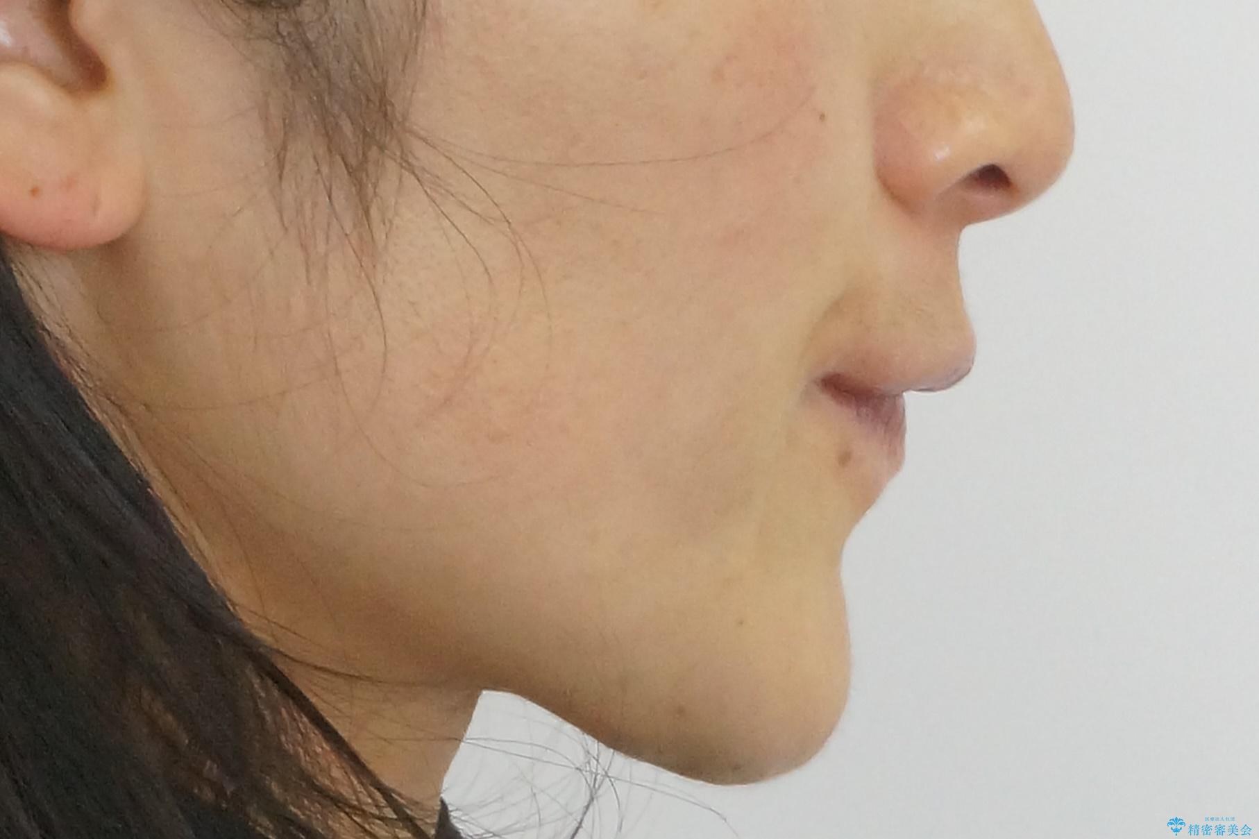 八重歯 上下の正中のずれ 40代で抜歯矯正の治療後(顔貌)