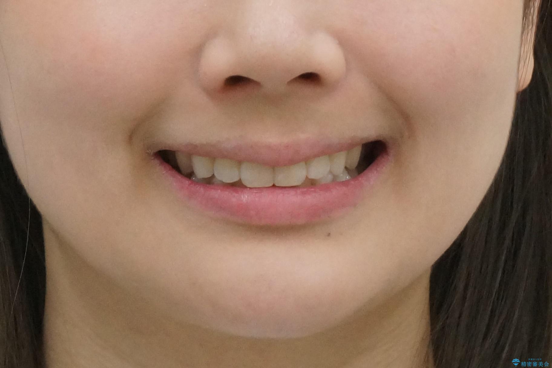 昔ワイヤー矯正をして後戻りした 軽度のがたつき モニター矯正の治療後(顔貌)